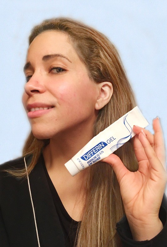 Differin-gel-adaplene-gel-acnue-treatment-adult-acne-pimple-help-solve